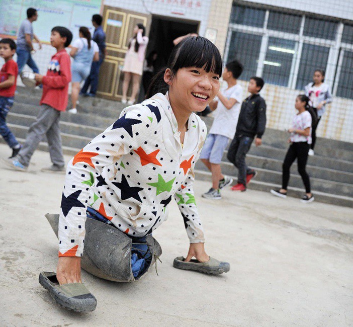 Amputee girl stick to her dream in 12 years